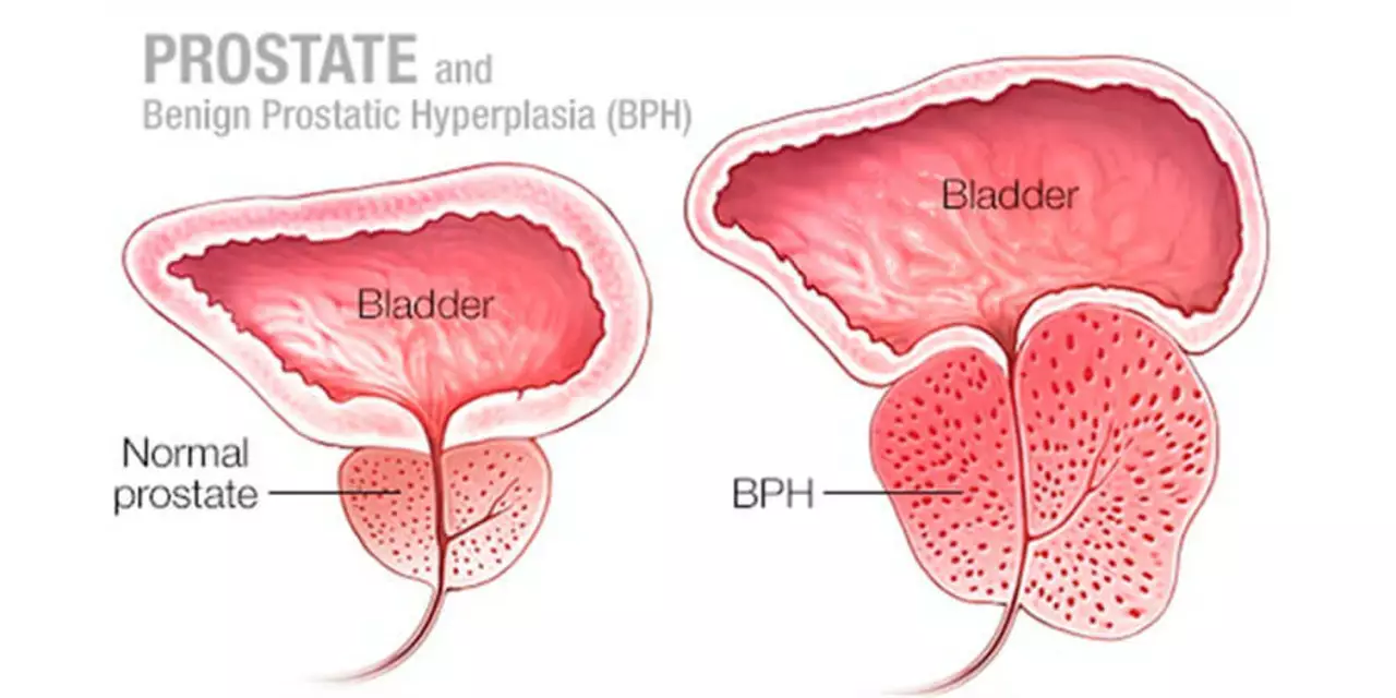Treatment Options for Benign Prostatic Hyperplasia: What You Need to Know